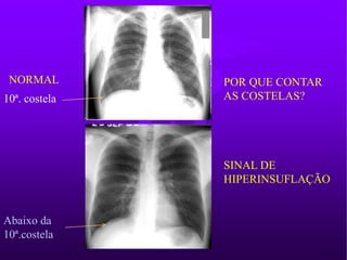 NORMAL
Abaixo da
10ª.costela
POR QUE CONTAR
AS COSTELAS?
SINAL DE
HIPERINSUFLAÇÃO
10ª. costela
 