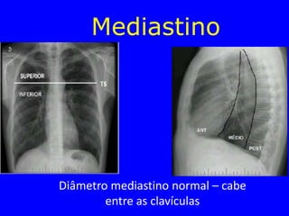Mediastino
Diâmetro mediastino normal – cabe
entre as clavículas
 