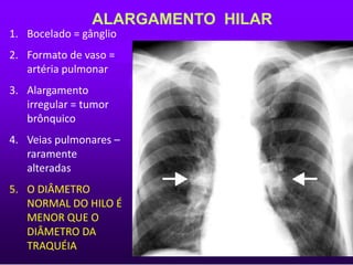 ALARGAMENTO HILAR
1. Bocelado = gânglio
2. Formato de vaso =
artéria pulmonar
3. Alargamento
irregular = tumor
brônquico
4. Veias pulmonares –
raramente
alteradas
5. O DIÂMETRO
NORMAL DO HILO É
MENOR QUE O
DIÂMETRO DA
TRAQUÉIA
 