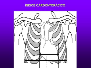 ÍNDICE CÁRDIO-TORÁCICO
 