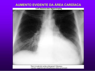 AUMENTO EVIDENTE DA ÁREA CARDÍACA
 