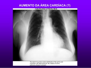 AUMENTO DA ÁREA CARDÍACA (?)
 