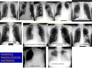 NODULO MASSA NODULOS MULTIPLOS DERRAME PLEURAL
CAVIDADES
ALARGAMENTO HILAR
ALARGAMENTO MEDIASTINO
HIPERTRANSPARENCIA
BILATERAL
CONDENSAÇÃO
ATELECTASIA
DOENÇA DIFUSA
PADRÕES
RADIOLÓGICOS
ANORMAIS
 