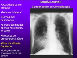 PADRÃO ACINAR:
Condensação ou Consolidação
•Opacidade de cor
irregular
•Pode ser bilateral
•Bordos mal
delimitados
•Bordos delimitados
apenas nas cisuras,
às vezes
•Presença de
broncograma aéreo
•Sinal da silhueta
freqüente
•Etiologias variadas:
pneumonia causa mais
comum
 