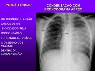CONDENSAÇÃO COM
BRONCOGRAMA AÉREO
OS BRÔNQUIOS ESTÃO
CHEIOS DE AR,
ENVOLVIDOS PELA
CONDENSAÇÃO,
TORNANDO-SE VISÍVEL
O DESENHO DOS
MESMOS,
DENTRO DA
CONDENSAÇÃO
PADRÃO ACINAR:
 
