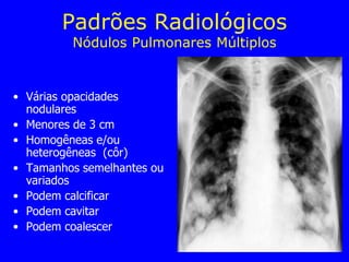 • Várias opacidades
nodulares
• Menores de 3 cm
• Homogêneas e/ou
heterogêneas (côr)
• Tamanhos semelhantes ou
variados
• Podem calcificar
• Podem cavitar
• Podem coalescer
Padrões Radiológicos
Nódulos Pulmonares Múltiplos
 