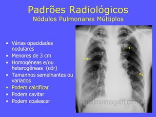 • Várias opacidades
nodulares
• Menores de 3 cm
• Homogêneas e/ou
heterogêneas (côr)
• Tamanhos semelhantes ou
variados
• Podem calcificar
• Podem cavitar
• Podem coalescer
Padrões Radiológicos
Nódulos Pulmonares Múltiplos
 