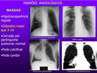 MASSAS
•Hipotransparência
regular
•Diâmetro maior
que 3 cm
•Cercada por
parênquima
pulmonar normal
•Pode calcificar
•Pode cavitar
Meta colon
Paracoccidioidomicose
Carcinoma broncogênico
Abscesso pulmonar
PADRÕES RADIOLÓGICOS
 