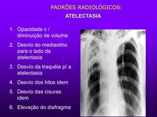 ATELECTASIA
1. Opacidade c /
diminuição de volume
2. Desvio do mediastino
para o lado da
atelectasia
3. Desvio da traquéia p/ a
atelectasia
4. Desvio dos hilos idem
5. Desvio das cisuras
idem
6. Elevação do diafragma
PADRÕES RADIOLÓGICOS:
 
