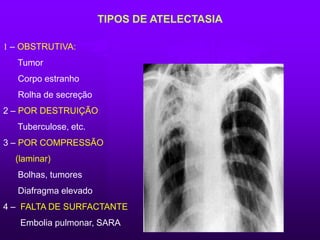 TIPOS DE ATELECTASIA
1 – OBSTRUTIVA:
Tumor
Corpo estranho
Rolha de secreção
2 – POR DESTRUIÇÃO:
Tuberculose, etc.
3 – POR COMPRESSÃO
(laminar)
Bolhas, tumores
Diafragma elevado
4 – FALTA DE SURFACTANTE
Embolia pulmonar, SARA
 