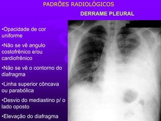 DERRAME PLEURAL
•Opacidade de cor
uniforme
•Não se vê angulo
costofrênico e/ou
cardiofrênico
•Não se vê o contorno do
diafragma
•Linha superior côncava
ou parabólica
•Desvio do mediastino p/ o
lado oposto
•Elevação do diafragma
PADRÕES RADIOLÓGICOS
 