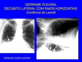 DERRAME PLEURAL
DECÚBITO LATERAL COM RAIOS HORIZONTAIS:
Incidência de Laurell
DERRAME SUBPULMONAR
 