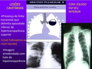 •Presença de linha
horizontal que
delimita opacidade
inferior de
hipertransparência
superior
•nível hidroaéreo ou
nível líquido)
•Imagem
arredondada com
halo de
hipotransparência
LESÕES
CAVITÁRIAS
COM LÍQUIDO
EM SEU
INTERIOR
 