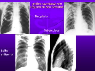 LESÕES CAVITÁRIAS SEM
LÍQUIDO EM SEU INTERIOR
Neoplasia
Tuberculose
Bolha
enfisema
 