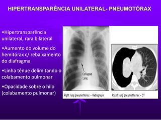 HIPERTRANSPARÊNCIA UNILATERAL- PNEUMOTÓRAX
•Hipertransparência
unilateral, rara bilateral
•Aumento do volume do
hemitórax c/ rebaixamento
do diafragma
•Linha tênue delimitando o
colabamento pulmonar
•Opacidade sobre o hilo
(colabamento pulmonar)
 
