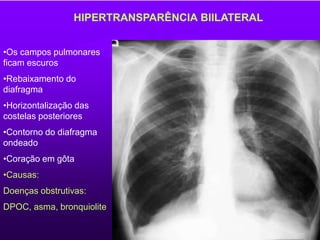 HIPERTRANSPARÊNCIA BIILATERAL
•Os campos pulmonares
ficam escuros
•Rebaixamento do
diafragma
•Horizontalização das
costelas posteriores
•Contorno do diafragma
ondeado
•Coração em gôta
•Causas:
Doenças obstrutivas:
DPOC, asma, bronquiolite
 