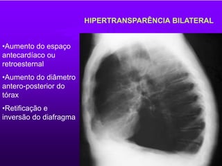 HIPERTRANSPARÊNCIA BILATERAL
•Aumento do espaço
antecardíaco ou
retroesternal
•Aumento do diâmetro
antero-posterior do
tórax
•Retificação e
inversão do diafragma
 