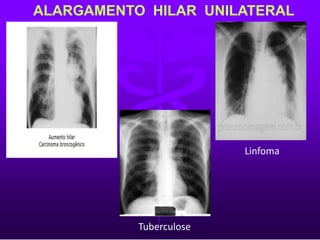 ALARGAMENTO HILAR UNILATERAL
Tuberculose
Linfoma
 