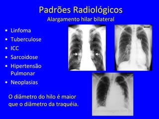 Padrões Radiológicos
Alargamento hilar bilateral
• Linfoma
• Tuberculose
• ICC
• Sarcoidose
• Hipertensão
Pulmonar
• Neoplasias
O diâmetro do hilo é maior
que o diâmetro da traquéia.
 