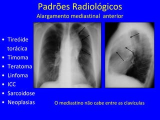 Padrões Radiológicos
Alargamento mediastinal anterior
• Tireóide
torácica
• Timoma
• Teratoma
• Linfoma
• ICC
• Sarcoidose
• Neoplasias O mediastino não cabe entre as clavículas
 