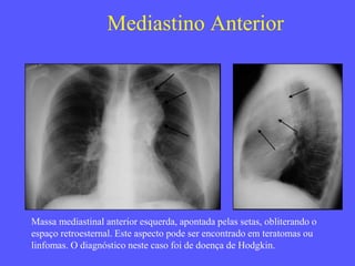 Mediastino Anterior
Massa mediastinal anterior esquerda, apontada pelas setas, obliterando o
espaço retroesternal. Este aspecto pode ser encontrado em teratomas ou
linfomas. O diagnóstico neste caso foi de doença de Hodgkin.
 