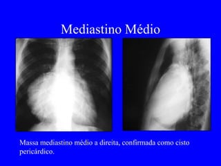Mediastino Médio
Massa mediastino médio a direita, confirmada como cisto
pericárdico.
 