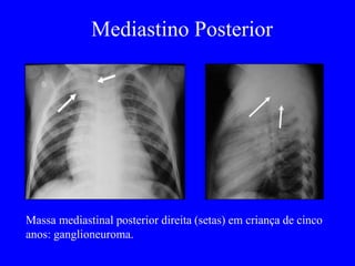 Mediastino Posterior
Massa mediastinal posterior direita (setas) em criança de cinco
anos: ganglioneuroma.
 
