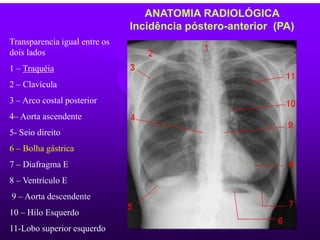 ANATOMIA RADIOLÓGICA
Incidência póstero-anterior (PA)
Transparencia igual entre os
dois lados
1 – Traquéia
2 – Clavícula
3 – Arco costal posterior
4– Aorta ascendente
5- Seio direito
6 – Bolha gástrica
7 – Diafragma E
8 – Ventrículo E
9 – Aorta descendente
10 – Hilo Esquerdo
11-Lobo superior esquerdo
 
