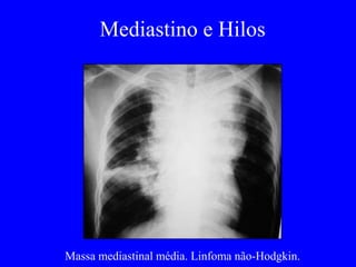 Mediastino e Hilos
Massa mediastinal média. Linfoma não-Hodgkin.
 