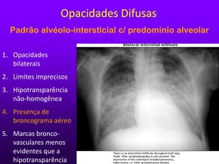 Padrão alvéolo-intersticial c/ predomínio alveolar
1. Opacidades
bilaterais
2. Limites imprecisos
3. Hipotransparência
não-homogênea
4. Presença de
broncograma aéreo
5. Marcas bronco-
vasculares menos
evidentes que a
hipotransparência
Opacidades Difusas
 