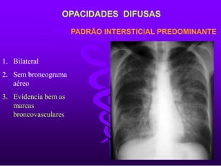 PADRÃO INTERSTICIAL PREDOMINANTE
OPACIDADES DIFUSAS
1. Bilateral
2. Sem broncograma
aéreo
3. Evidencia bem as
marcas
broncovasculares
 