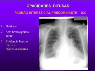 PADRÃO INTERSTICIAL PREDOMINANTE - ICC
OPACIDADES DIFUSAS
1. Bilateral
2. Sem broncograma
aéreo
3. Evidencia bem as
marcas
broncovasculares
 