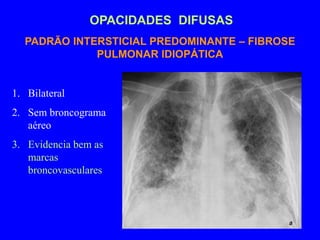 PADRÃO INTERSTICIAL PREDOMINANTE – FIBROSE
PULMONAR IDIOPÁTICA
OPACIDADES DIFUSAS
1. Bilateral
2. Sem broncograma
aéreo
3. Evidencia bem as
marcas
broncovasculares
 