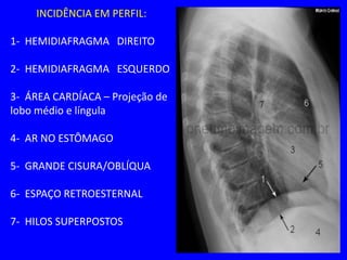 INCIDÊNCIA EM PERFIL:
1- HEMIDIAFRAGMA DIREITO
2- HEMIDIAFRAGMA ESQUERDO
3- ÁREA CARDÍACA – Projeção de
lobo médio e língula
4- AR NO ESTÔMAGO
5- GRANDE CISURA/OBLÍQUA
6- ESPAÇO RETROESTERNAL
7- HILOS SUPERPOSTOS
 