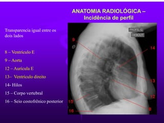 ANATOMIA RADIOLÓGICA –
Incidência de perfil
Transparencia igual entre os
dois lados
8 – Ventrículo E
9 – Aorta
12 – Aurícula E
13– Ventrículo direito
14- Hilos
15 – Corpo vertebral
16 – Seio costofrênico posterior
 