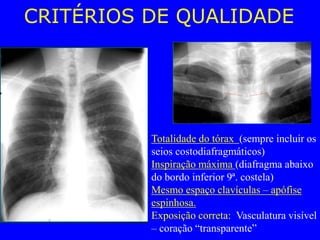 CRITÉRIOS DE QUALIDADE
Totalidade do tórax (sempre incluir os
seios costodiafragmáticos)
Inspiração máxima (diafragma abaixo
do bordo inferior 9ª. costela)
Mesmo espaço clavículas – apófise
espinhosa.
Exposição correta: Vasculatura visível
– coração “transparente”
 