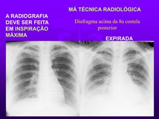 MÁ TÉCNICA RADIOLÓGICA
A RADIOGRAFIA
DEVE SER FEITA
EM INSPIRAÇÃO
MÁXIMA
EXPIRADA
Diafragma acima da 8a costela
posterior
 