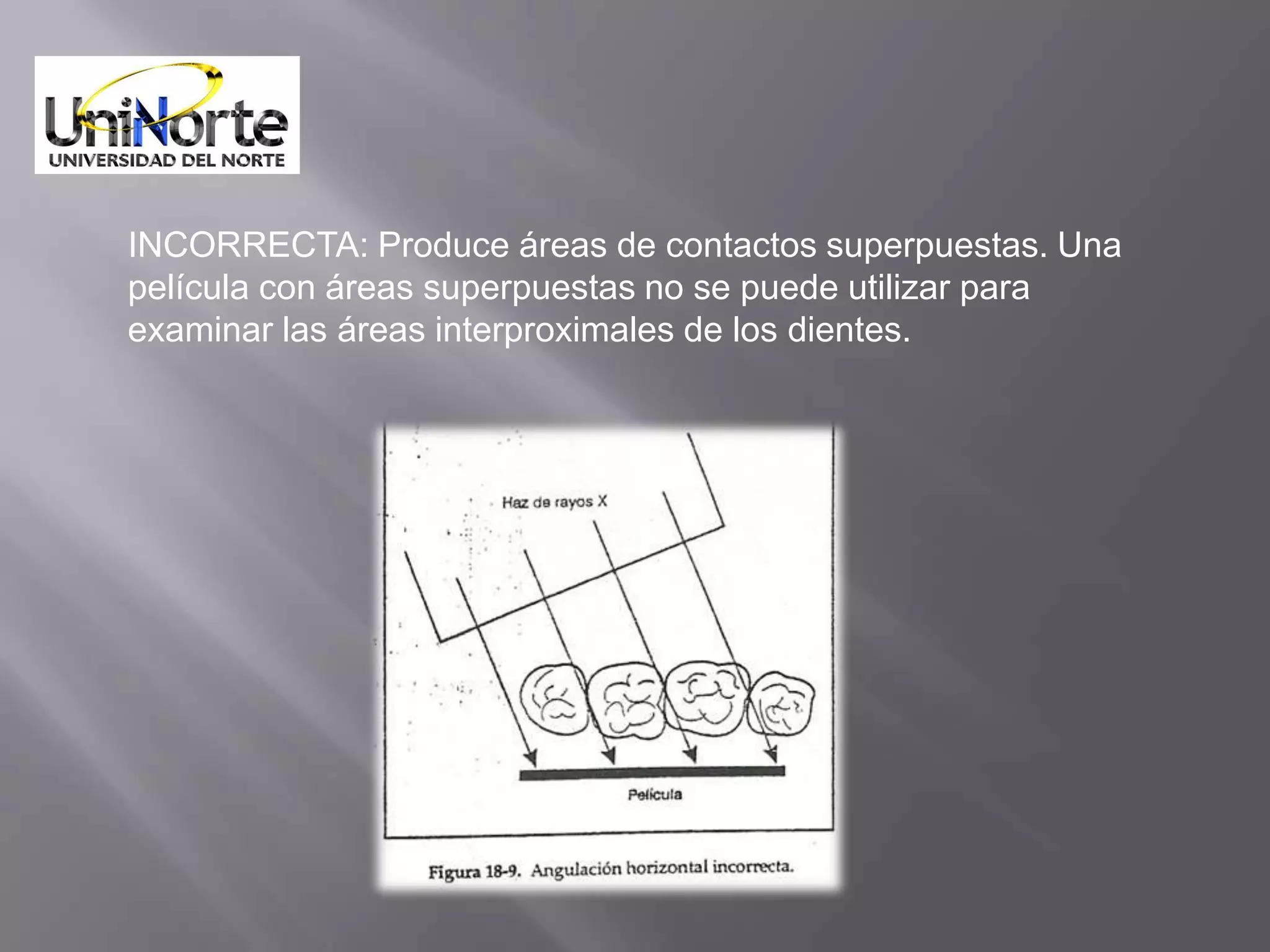 INCORRECTA: Produce áreas de contactos superpuestas. Una
película con áreas superpuestas no se puede utilizar para
examinar las áreas interproximales de los dientes.
 