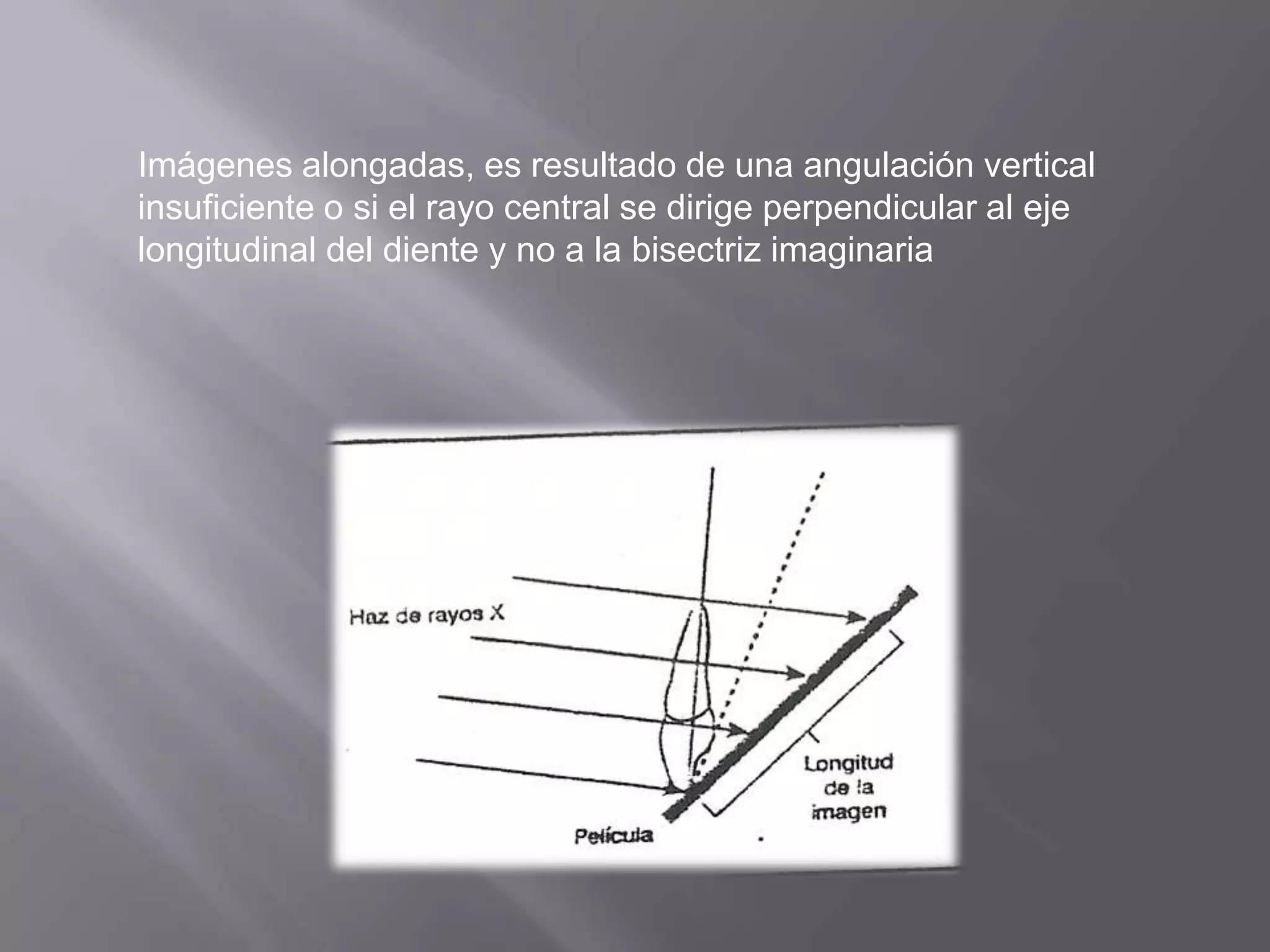 Imágenes alongadas, es resultado de una angulación vertical
insuficiente o si el rayo central se dirige perpendicular al eje
longitudinal del diente y no a la bisectriz imaginaria
 