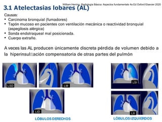 iDESIGN
by HiSlide.io
Causas:
• Carcinoma bronquial (fumadores)
• Tapón mucoso en pacientes con ventilación mecánica o reactividad bronquial
(aspegilosis alérgica)
• Sonda endotraqueal mal posicionada.
• Cuerpo extraño.
A veces las AL producen únicamente discreta pérdida de volumen debido a
la hiperinsulﬂación compensatoria de otras partes del pulmón
3.1 Atelectasias lobares (AL)
LSD LM
LID
LÓBULOSDERECHOS LÓBULOSIZQUIERDOS
LSI
LII
William Herring, Radiología Básica: Aspectos fundamentals 4a Ed Oxford Elsevier 2020
 