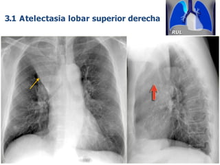 iDESIGN
by HiSlide.io 61
LSD
3.1 Atelectasia lobar superior derecha
 