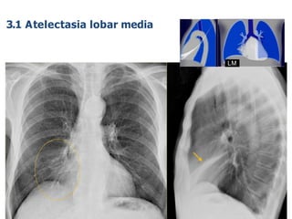 iDESIGN
by HiSlide.io
62
LM
3.1 Atelectasia lobar media
 