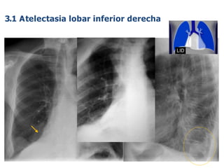 iDESIGN
by HiSlide.io
63
LID
3.1 Atelectasia lobar inferior derecha
 