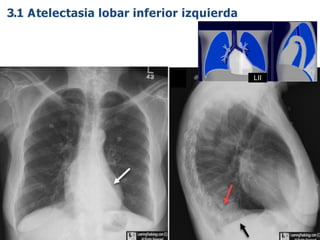 iDESIGN
by HiSlide.io 65
LII
3.1 Atelectasia lobar inferior izquierda
 