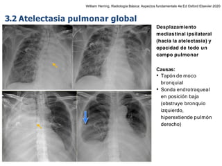 iDESIGN
by HiSlide.io
Desplazamiento
mediastinal ipsilateral
(hacia la atelectasia) y
opacidad de todo un
campo pulmonar
Causas:
• Tapón de moco
bronquial
• Sonda endrotraqueal
en posición baja
(obstruye bronquio
izquierdo,
hiperextiende pulmón
derecho)
3.2 Atelectasia pulmonar global
William Herring, Radiología Básica: Aspectos fundamentals 4a Ed Oxford Elsevier 2020
 