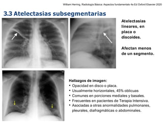 iDESIGN
by HiSlide.io
Hallazgos de imagen:
• Opacidad en disco o placa.
• Usualmente horizontales, 45% oblicuas
• Comunes en porciones mediales y basales.
• Frecuentes en pacientes de Terapia Intensiva.
• Asociadas a otras anormalidades pulmonares,
pleurales, diafragmáticas o abdominales.
3.3 Atelectasias subsegmentarias
Atelectasias
lineares, en
placa o
discoides.
Afectan menos
de un segmento.
William Herring, Radiología Básica: Aspectos fundamentals 4a Ed Oxford Elsevier 2020
 
