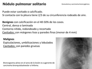 Nódulo pulmonar solitario
Puede estar cavitado o calcificado.
Si contacta con la pleura tiene 2/3 de su circunferencia rodeado de aire.
Benignos con calcificación en el 40-50% de los casos.
Central, densa o laminada
Contorno nítido, redondeado y recortado
Cavitados: con márgenes lisos y paredes finas (menor de 4 mm)
Granuloma y carcinoma broncogénico.
Malignos
Espiculaciones, umbilicaciones y lobulados
Cavitados: con paredes gruesas
Broncograma aéreo en el seno de la lesión es sugerente de
carcinoma bronquioloalveolar o linfoma.
 