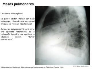 Masas pulmonares
Carcinoma broncogénico.
Se puede cavitar, incluso con nivel
hidroaéreo, observándose una pared
irregular y a veces un nódulo mural.
Aunque en proyección PA suele verse
una opacidad redondeada, es la
radiografía lateral la que confirma la
situación cisural. “tumor
evanescente”.
William Herring, Radiología Básica: Aspectos fundamentals 4a Ed Oxford Elsevier 2020
 