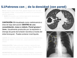 iDESIGN
by HiSlide.io
BULA: Espacio aéreo (EA) >1cm, pared delgada bien deﬁnida
con grosor ≤ 1mm. Acompañada de cambios enﬁsematosos en
pulmón adyacente.
• BLEB: EA pequeño que contiene gas dentro de la pleura
visceral o pulmón subpleural (< 1cm)
CAVITACIÓN: EAvisualizado como radiolucencia o
área de baja atenuación DENTRO de una
consolidación, masa o nódulo. Pared gruesa >
3mm. Usualmente producida por la expulsión o
drenaje de parte de la lesión necrótica a través del
árbol bronquial. Puede contener nivel líquido.
QUISTE: EA redondo circunscrito rodeado de pared epitelial o
ﬁbrosa de <3mm. Contiene aire, ocasionalmente líquidos o
sólidos.
PANALIZACIÓN: Tejido pulmonar ﬁbrótico y destruído que
contiene numerosos quistes con pared ﬁbrosa. Pérdida de la
arquitectura acinar. Típica de la ﬁbrosis pulmonar.
NEUMATOCELE: Espacio aéreo con pared delgada. Usualmente
causado por neumonía, trauma o aspiración de hidrocarburos
5.1Patrones con ↓ de la densidad (con pared)
 