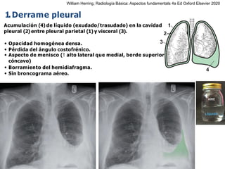iDESIGN
by HiSlide.io
1.Derrame pleural
1
2
3
4
Acumulación (4) de líquido (exudado/trasudado) en la cavidad
pleural (2) entre pleural parietal (1) y visceral (3).
• Opacidad homogénea densa.
• Pérdida del ángulo costofrénico.
• Aspecto de menisco (↑ alto lateral que medial, borde superior
cóncavo)
• Borramiento del hemidiafragma.
• Sin broncograma aéreo.
AIRE
LÍQUIDO
William Herring, Radiología Básica: Aspectos fundamentals 4a Ed Oxford Elsevier 2020
 